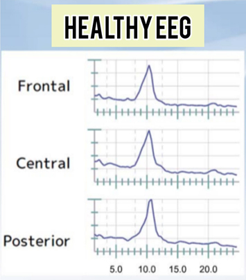 result EEG